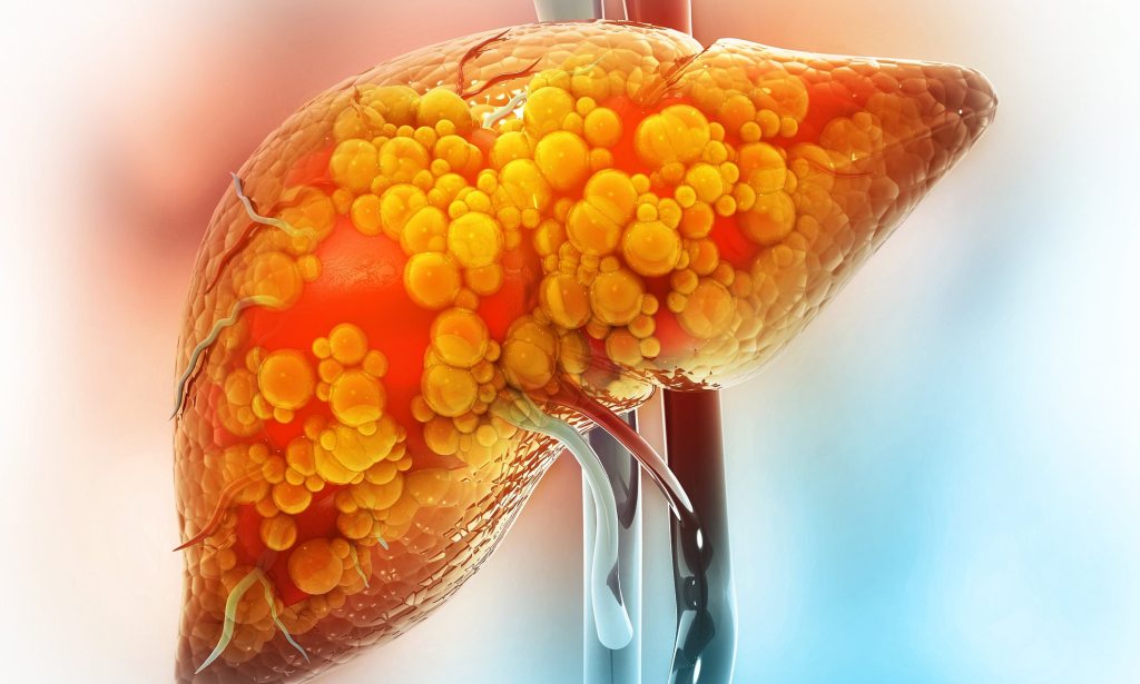 Breakthrough reveals cause of deadly liver disease – new treatment nears&nbsp;reality