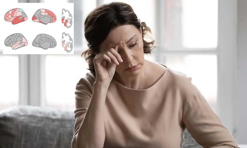 Brain Shape May Predict Dementia Risk Later in&nbsp;Life