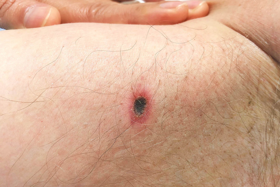 Indoor Scrub Typhus Outbreak in&nbsp;Kathmandu