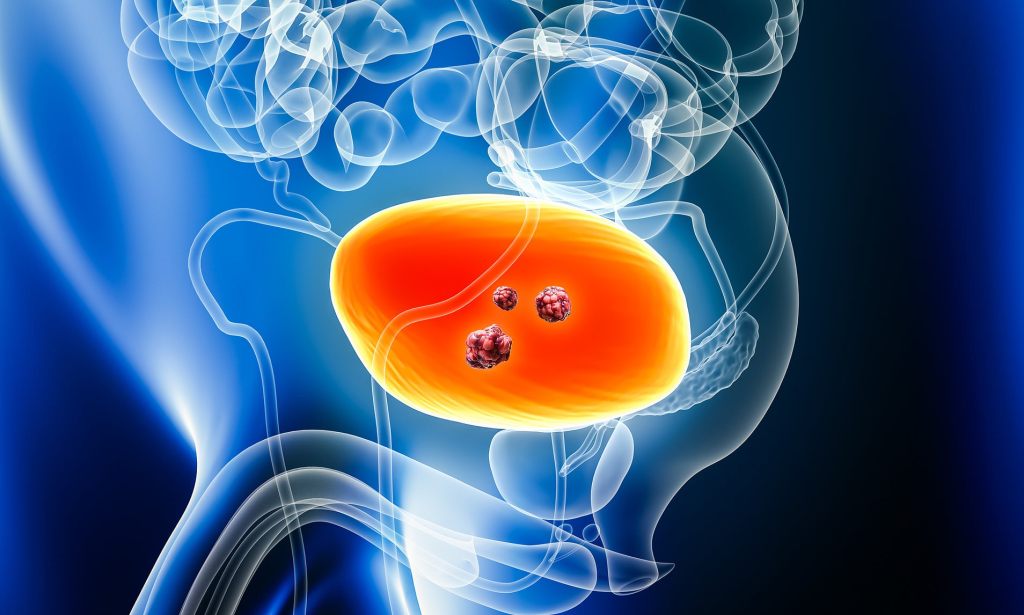 New Drug Offers Survival Hope for Bladder Cancer Patients on&nbsp;NHS